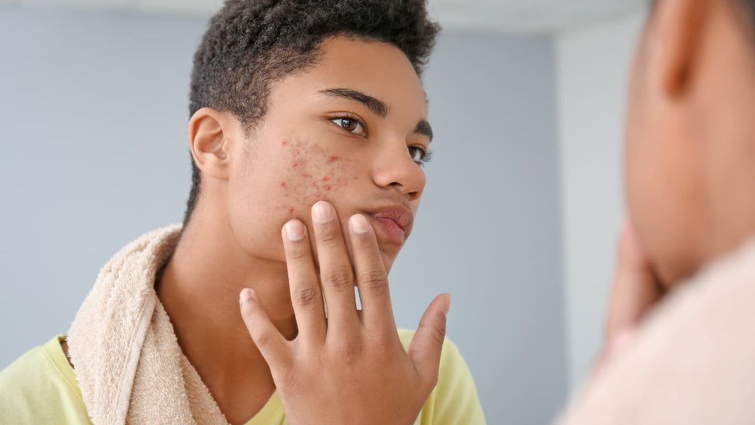 Acné chez les hommes à la peau noire : comment prendre soin de sa peau et prévenir les éruptions - Ethnilink