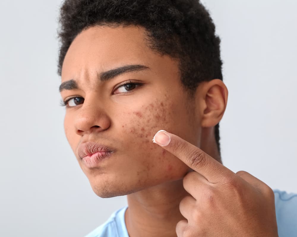 Acne skin